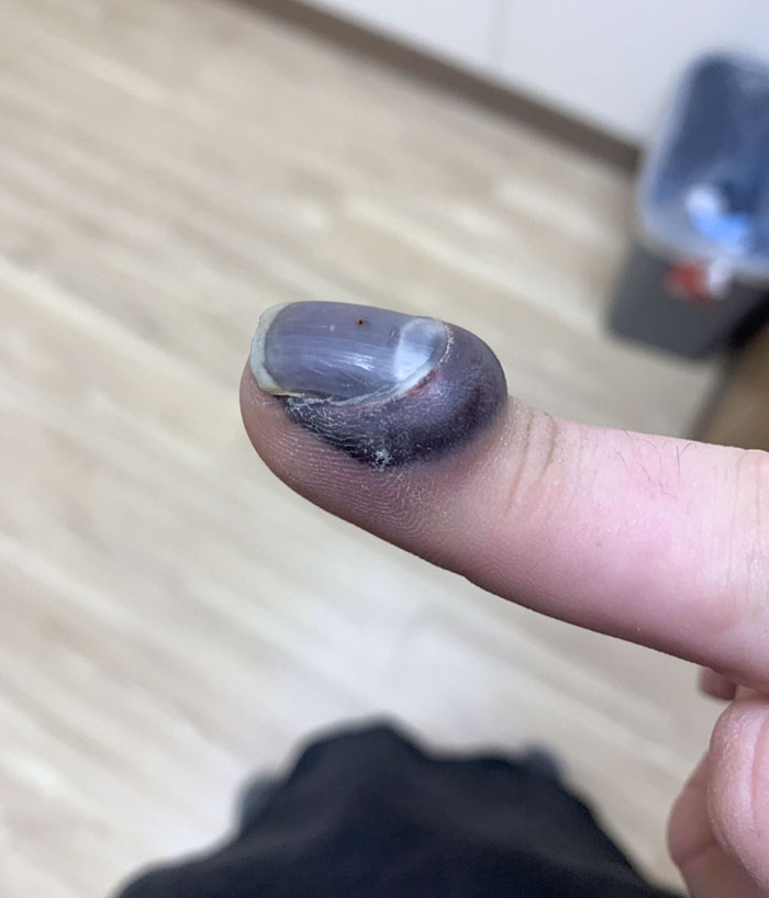 My Finger After Getting It Stuck In A Car Door