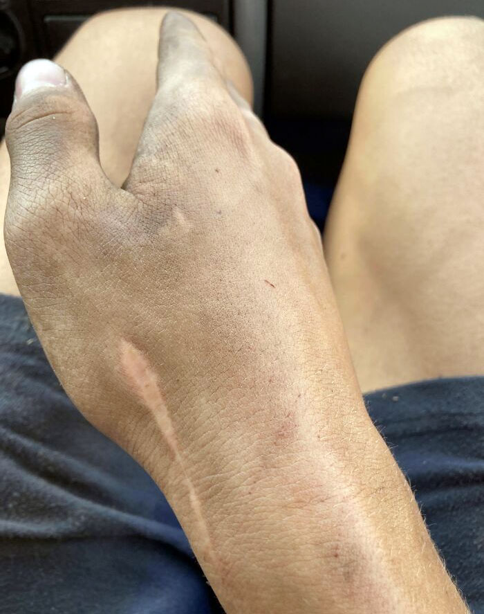 My Scar Doesnt Sweat Anymore So Dirt Doesnt Stick To It