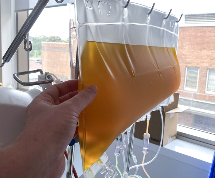 This Plasma Separated From My Blood Over A 3 Hour Sitting