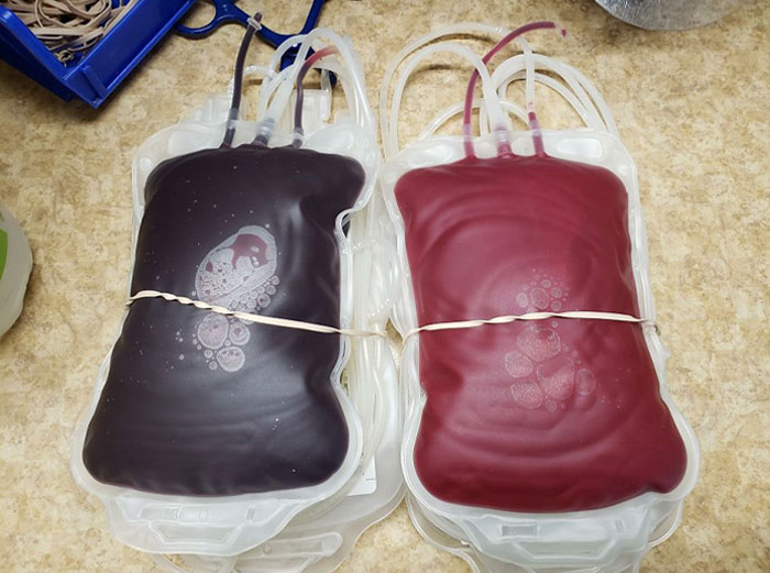 Blood From A Vein(Top Bag) And Blood From An Artery(Bottom Bag). Your Blood Is Just Darker With No Oxygen In It, Not Blue