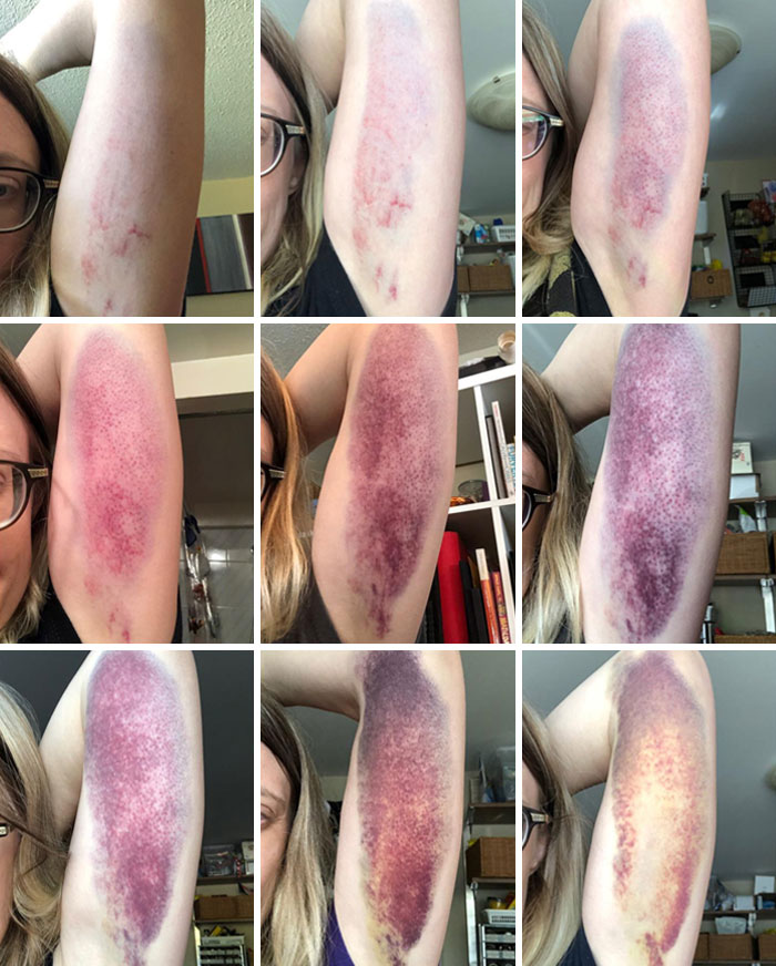 Bruise Progression