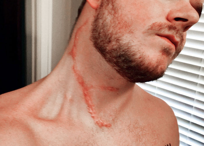 Scar From Carotid Artery Surgery