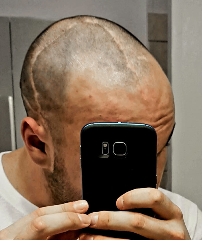 Brain Surgery Scars On The Top Of My Head
