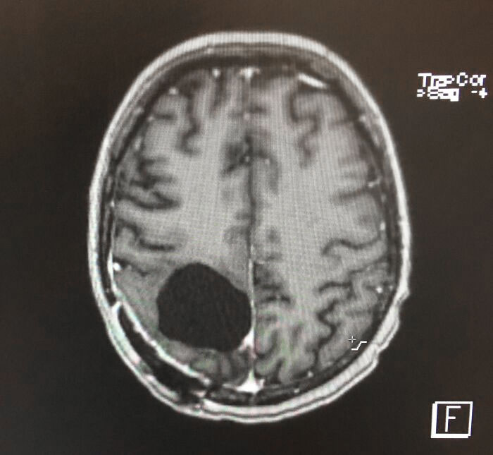 I Had A Brain Tumor Removed, And Now I’m A Bit Absent Minded
