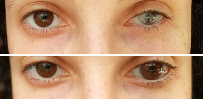 The Difference My Prosthetic Eye Makes