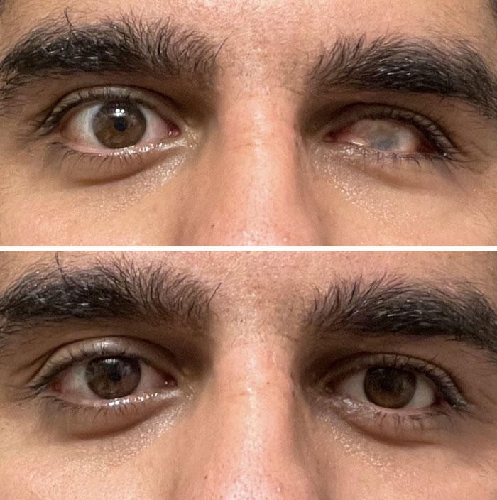 Before And After I Wear My Fake Eye