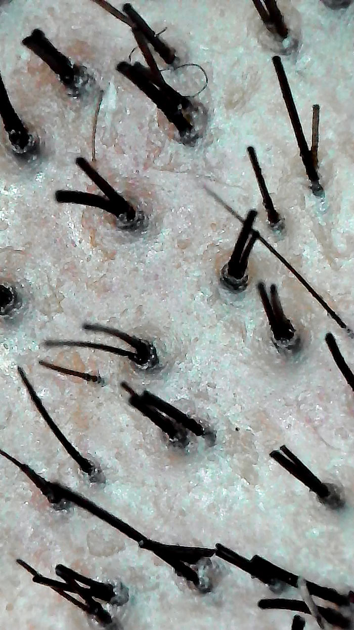 I Used A Microscope On My Shaved Head Realized My Hairs Grow In Pairs