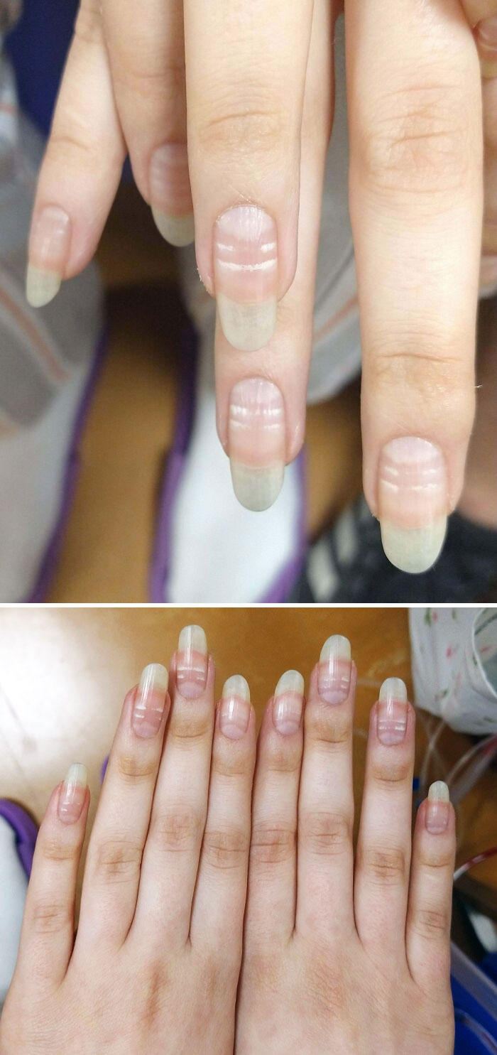How Chemotherapy Affect Nails