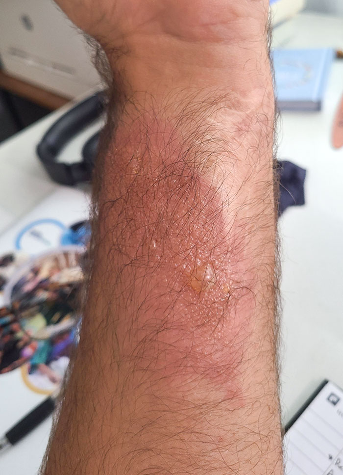 Poison Ivy Doesn't Cause A Rash On Scar Tissue