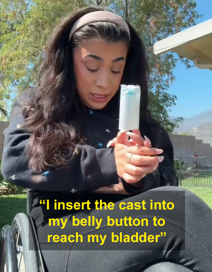 “It Was Worth The Pain”: Quadriplegic Influencer Talks About Peeing Through Her Belly Button “It Was Worth The Pain”: Quadriplegic Influencer Talks About Peeing Through Her Belly Button