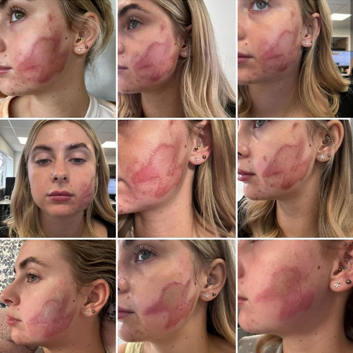 "Horrific": Woman Suffers Second-Degree Burns After Getting Popular Beauty Procedure "Horrific": Woman Suffers Second-Degree Burns After Getting Popular Beauty Procedure