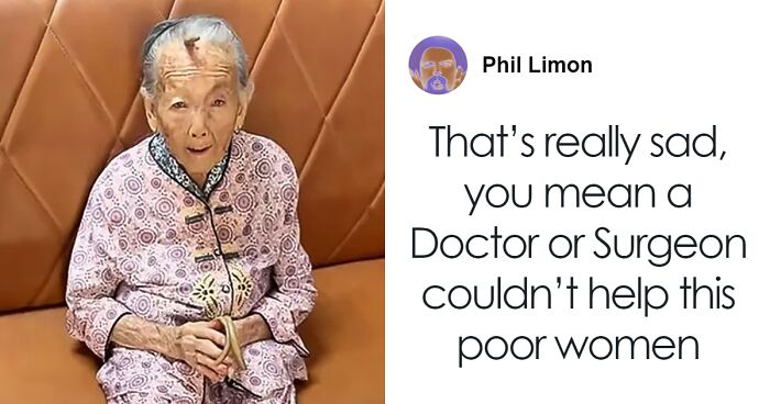 “It’s Too Risky”: 107YO Goes Viral For 4-Inch “Longevity Horn” Growing From Her Forehead