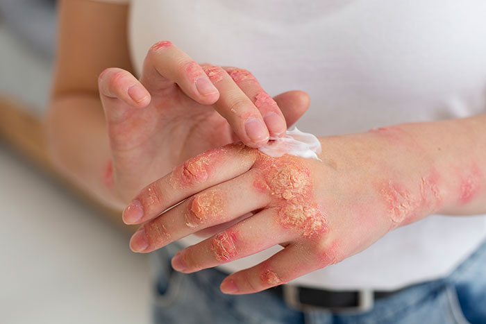 Woman Suspects Hubby Turned On Soft Water To &ldquo;Test&rdquo; Her Eczema, Worries About Her Marriage
