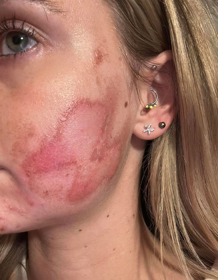 "Horrific": Woman Suffers Second-Degree Burns After Getting Popular Beauty Procedure "Horrific": Woman Suffers Second-Degree Burns After Getting Popular Beauty Procedure