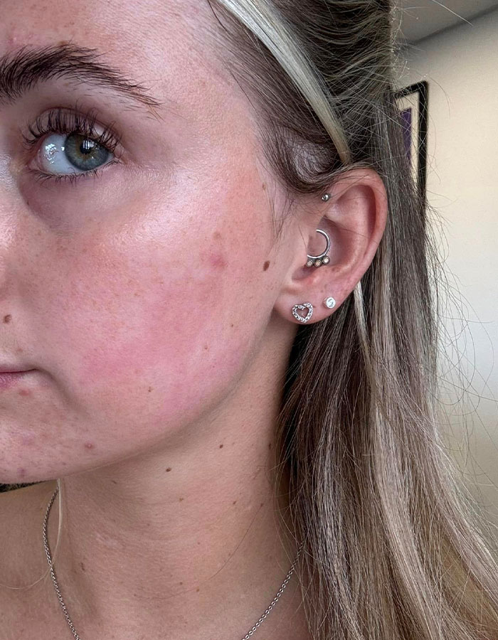 "Horrific": Woman Suffers Second-Degree Burns After Getting Popular Beauty Procedure "Horrific": Woman Suffers Second-Degree Burns After Getting Popular Beauty Procedure