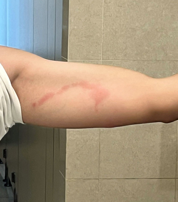 I Got Bit By A Mosquito Twice And A Line Joining Them Formed