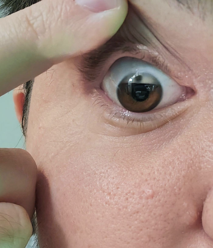 My Eye Is Gradually Losing Its Color