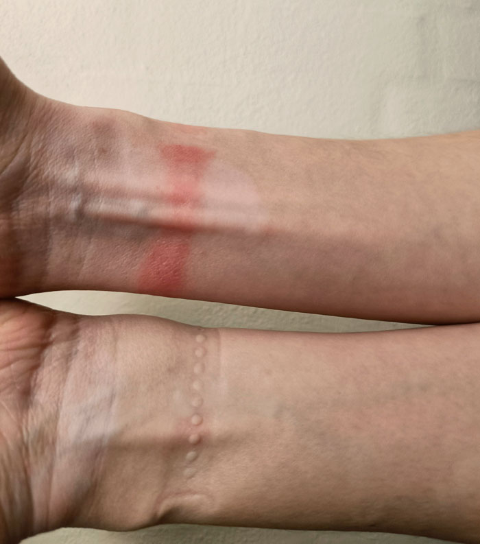 Only My Right Arm Is Allergic To My Wristwatch