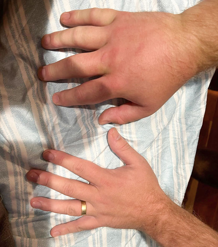 24 Hours After Being Stung By A Yellow Jacket On My Middle Upper Knuckle