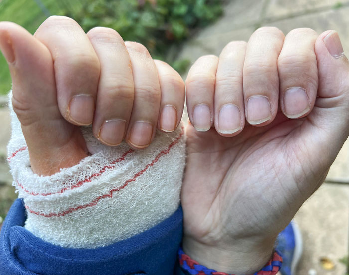 Broke My Arm - 1 Week Later Fingernails No Longer Grow At Same Rate