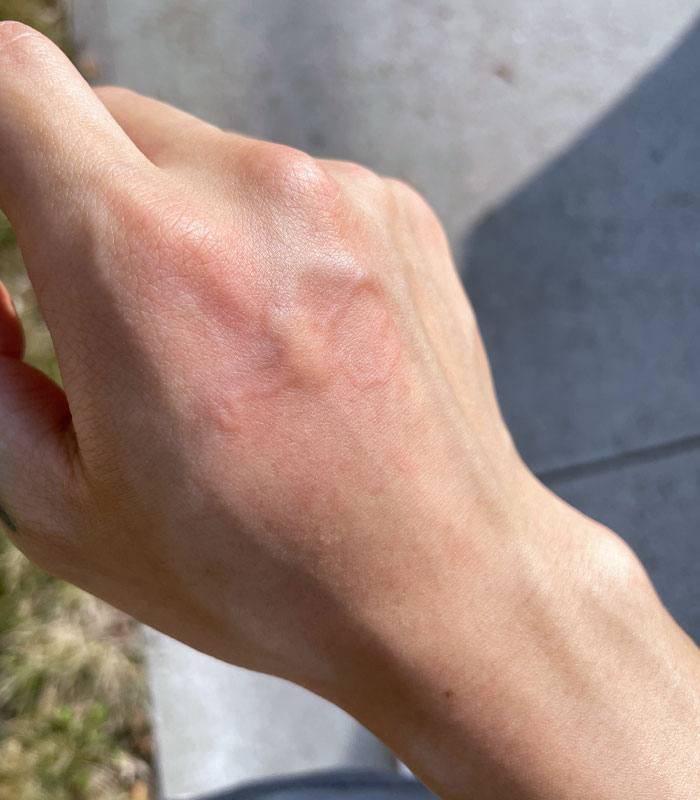 Weird Mosquito Bite