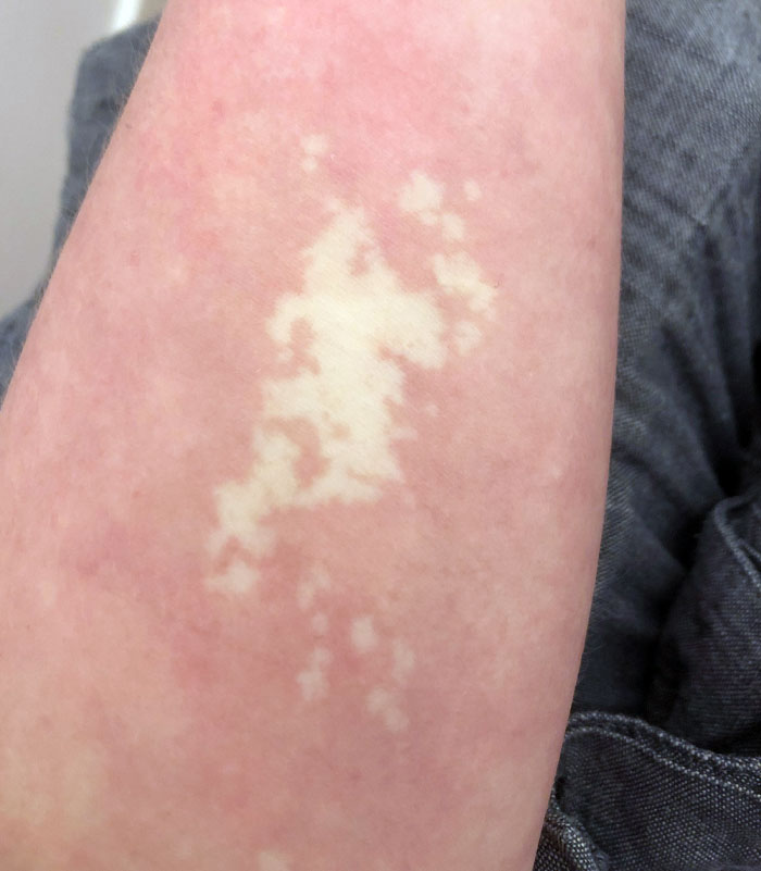 I Got Stung By A Jellyfish 20 Years Ago That’s Effected The Cells In My Skin Meaning It Can’t Change Colour Due To Temperature