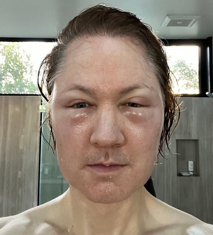 Billionaire Trying To Reverse Aging Injected Fat Into His Face&mdash;Reveals &ldquo;Disturbing&rdquo; Results