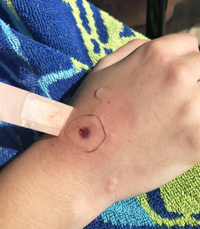An Octopus Bite Wound