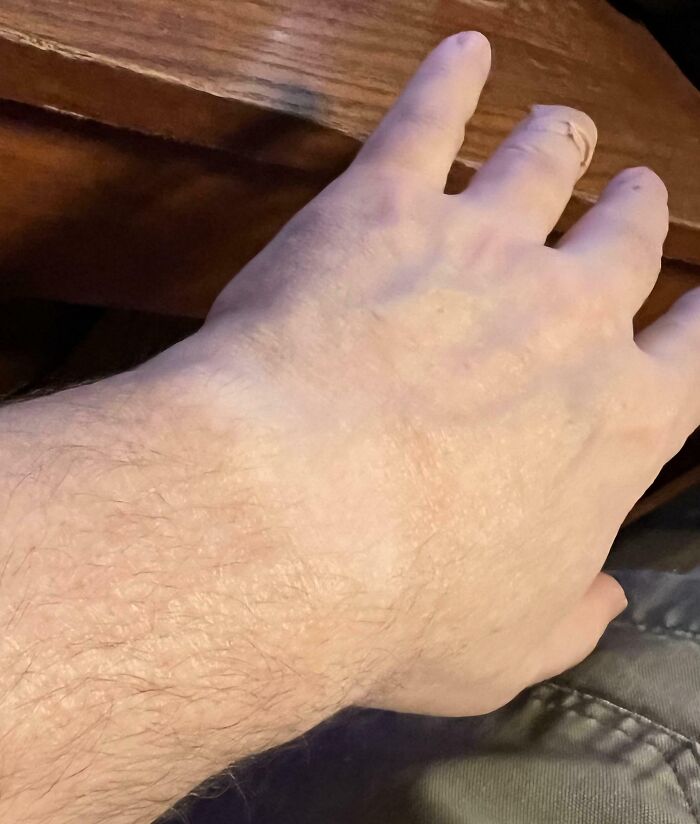 I Have Not Worn A Watch For Over 10 Years, But You Can Still See Where It Used To Be On My Arm