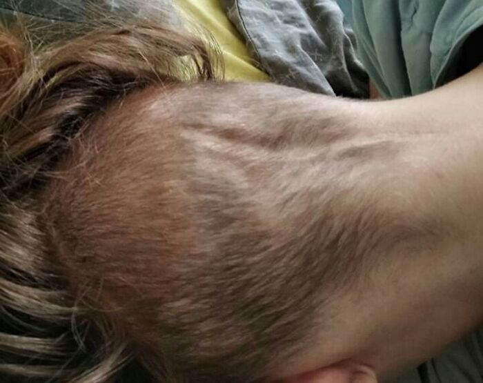 Growing My Hair Out After Radiotherapy. Part Of It Is Ginger, Part Of It Is Brown