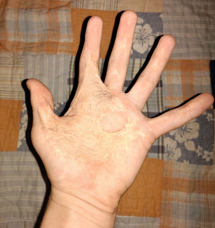 Burnt My Hand With An Iron At Age 1.5 This Is My Hand Almost 14 Years Later. Yes That Is Hair On My Hand