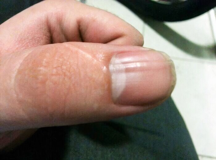 Scar Changed How My Thumb Nail Grows