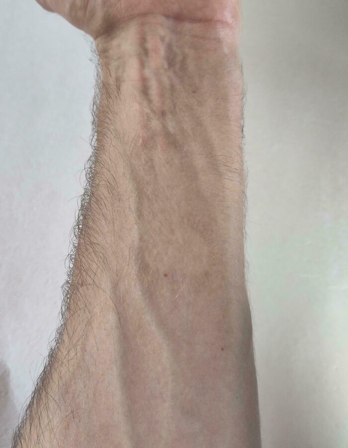 The Imprint Of My Mother's Thumb Burned Into My Forearm