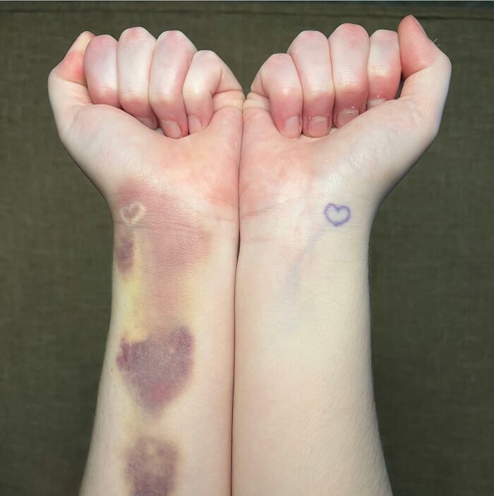 My Invisible (White) Tattoo Is Currently Visible