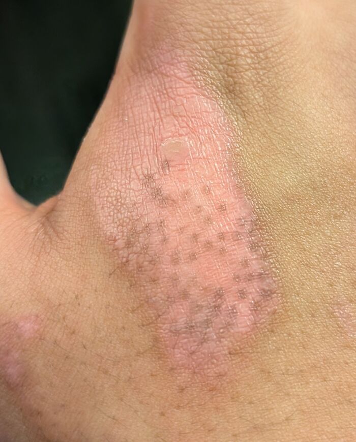 The Way The Color Is Coming Back On My Burn Wound