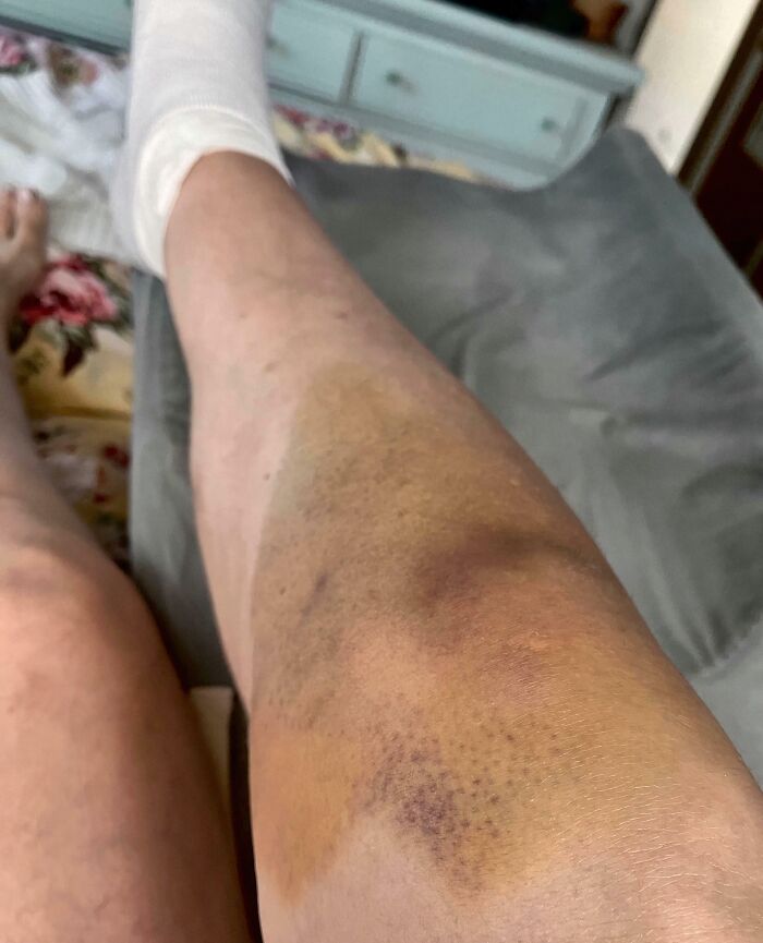 The Bruise On My Knee Traveled “Up” Because I’ve Had To Elevate My Leg