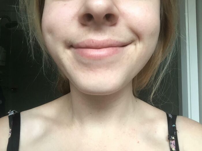 I Killed A Patch Of Nerves In My Cheek As A Child And Have Had A Lopsided Smile And One Dimple Ever Since