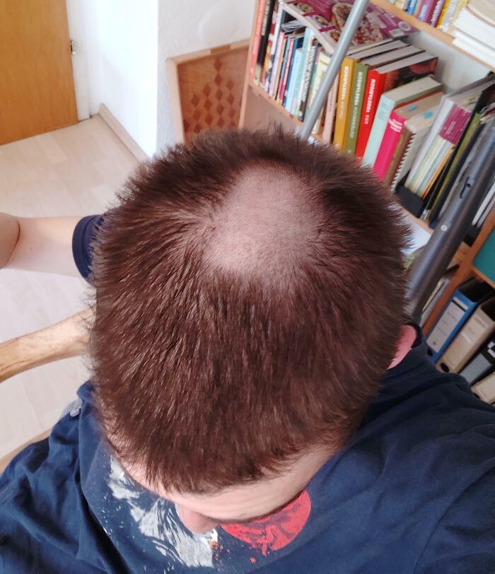 My Dad Forgot To Put The Spacer Back Onto The Machine When Cutting My Hair