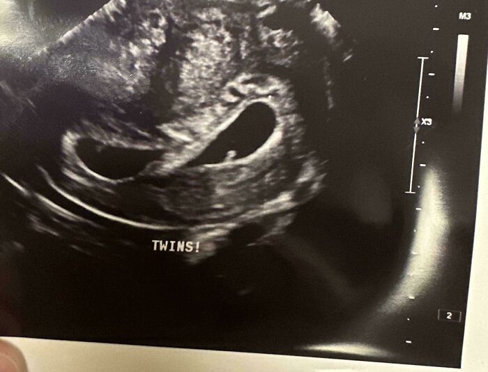 Ultrasound image showing early twin pregnancy, highlighting wholesome and funny dads doing their best moments.