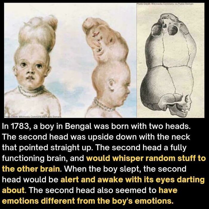 Creepy images of a two-headed boy from 1783, including drawings and a skull. Hair of kids anomalies.