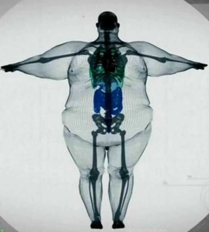 This Is The X-Ray Of Keith Martin, A 900 Pound Man Who Featured In A Channel 5 Documentary Titled “70 Stone And Almost Dead”