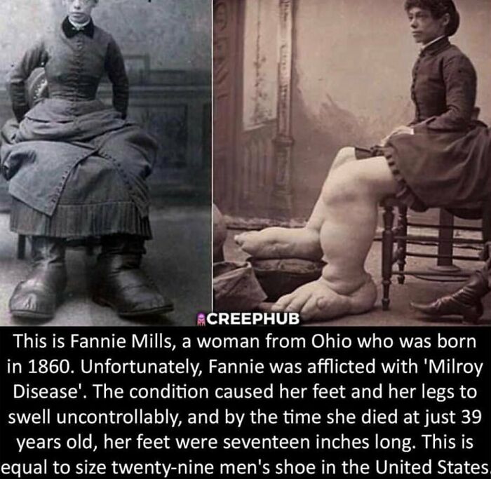 Black and white photos of Fannie Mills with Milroy Disease showing extremely swollen feet, a creepy weird fact shared on Instagram.