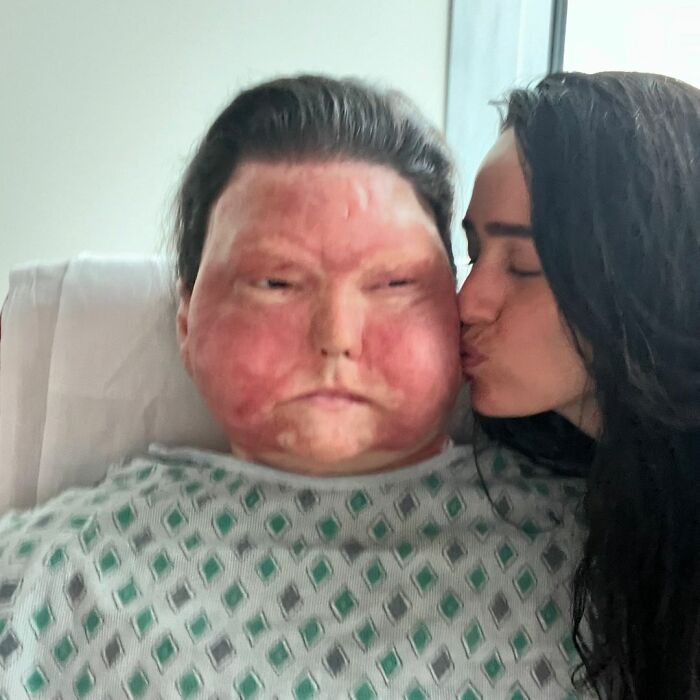 Man Who Had World’s First Face And Hands Transplant Shares Engagement Photos With Fiancée Man Who Had World’s First Face And Hands Transplant Shares Engagement Photos With Fiancée