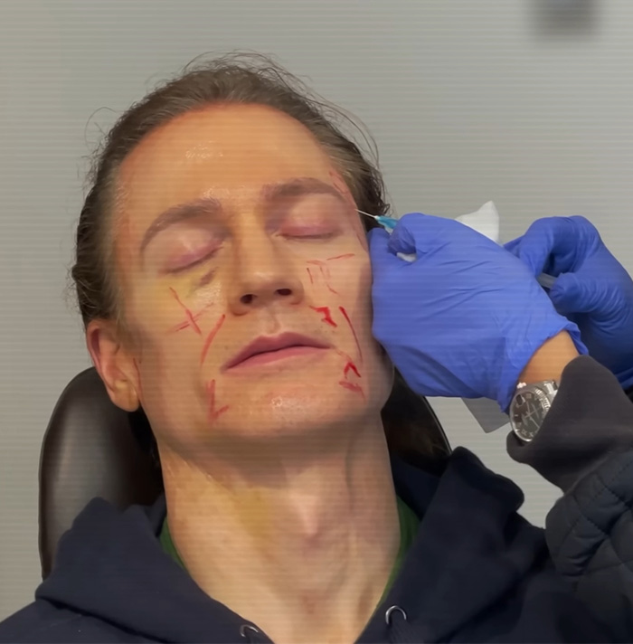 Billionaire Trying To Reverse Aging Injected Fat Into His Face&mdash;Reveals &ldquo;Disturbing&rdquo; Results