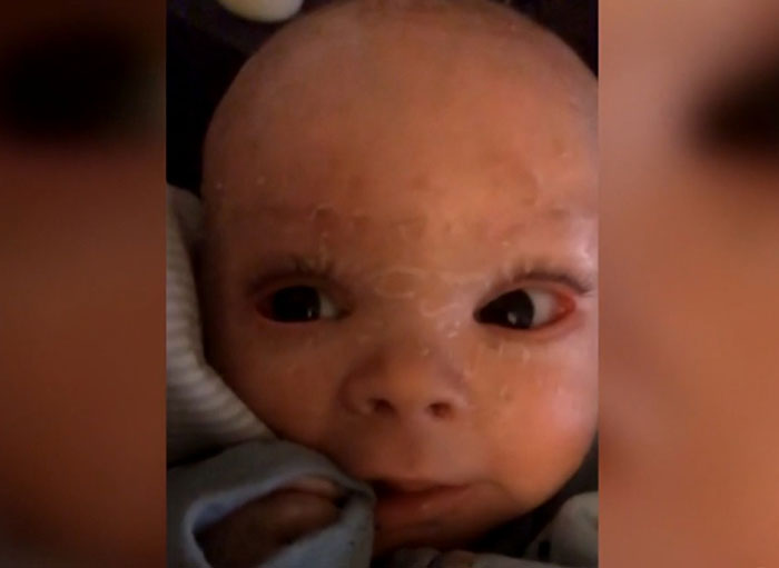 "Absolute Nightmare": 7YO With Rare Condition Sleeps With His Eyes Closed For The First Time