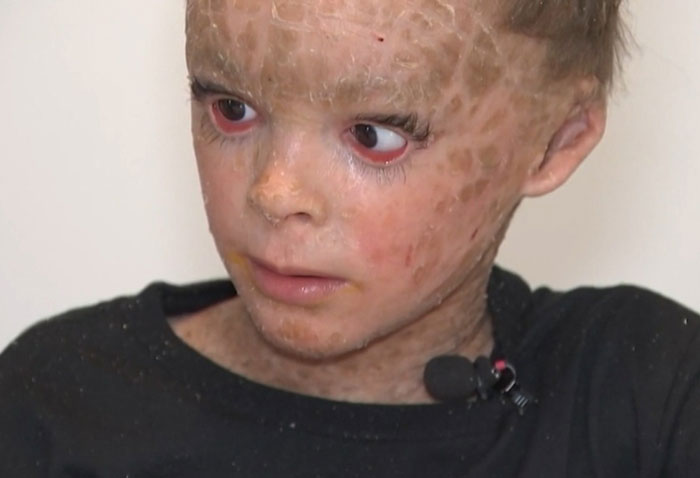 "Absolute Nightmare": 7YO With Rare Condition Sleeps With His Eyes Closed For The First Time