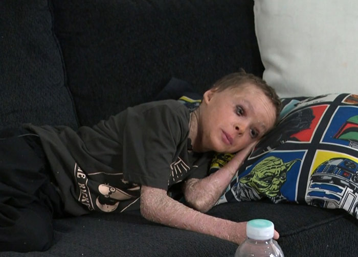 "Absolute Nightmare": 7YO With Rare Condition Sleeps With His Eyes Closed For The First Time
