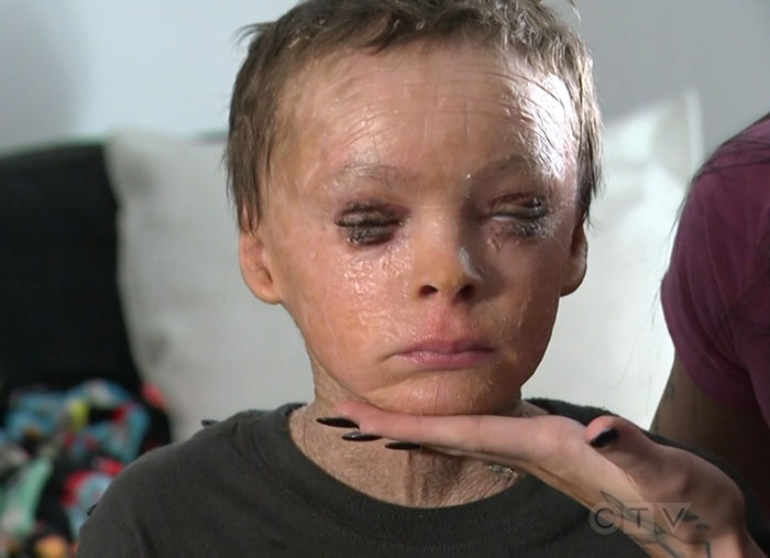 "Absolute Nightmare": 7YO With Rare Condition Sleeps With His Eyes Closed For The First Time