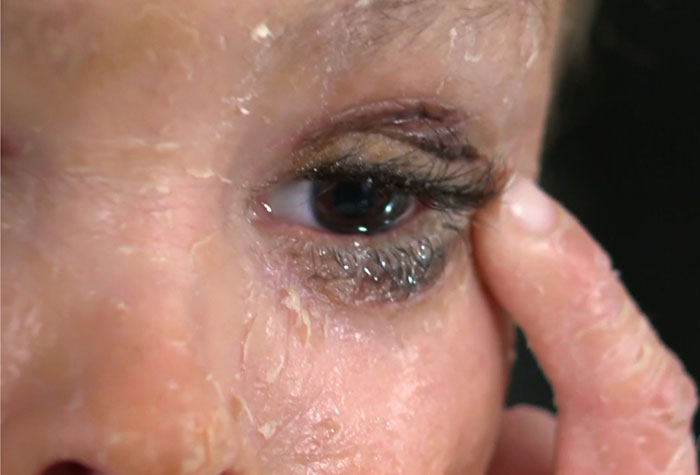 "Absolute Nightmare": 7YO With Rare Condition Sleeps With His Eyes Closed For The First Time