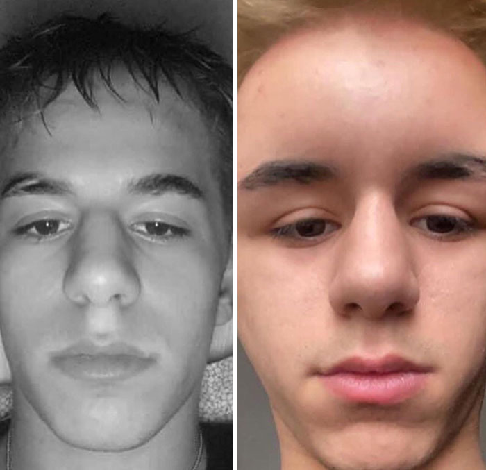 Mi amigo se tiñó el cabello: nos enteramos de que es alérgico